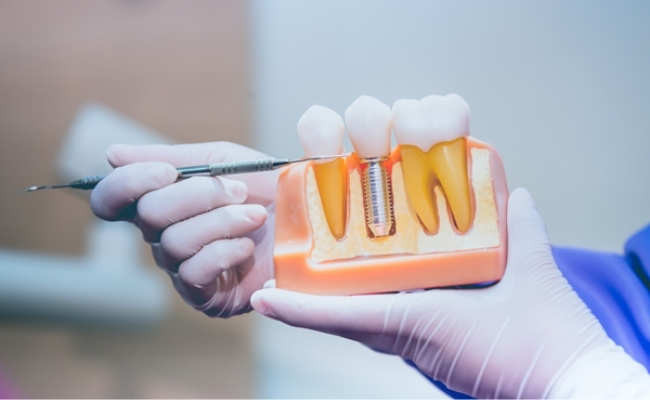 Dental Implants