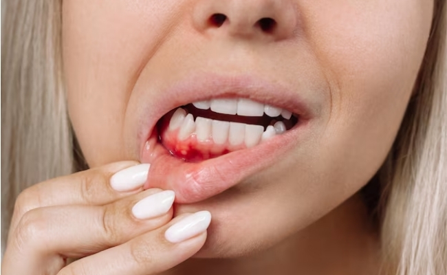 Gum Disease Treatment