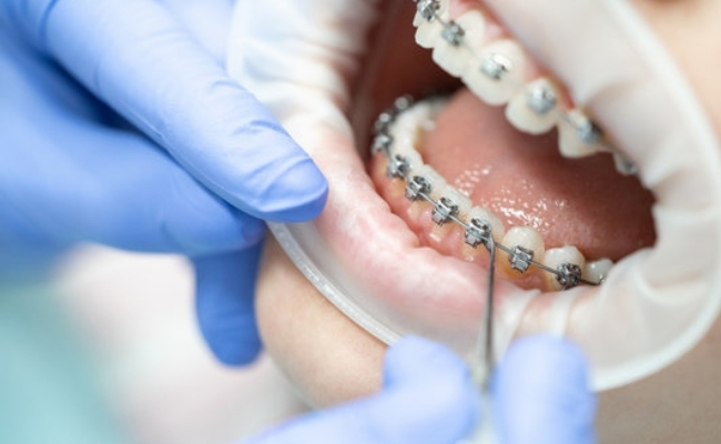 Orthodontic Treatment--