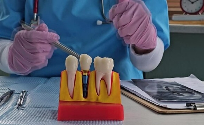Root Canals