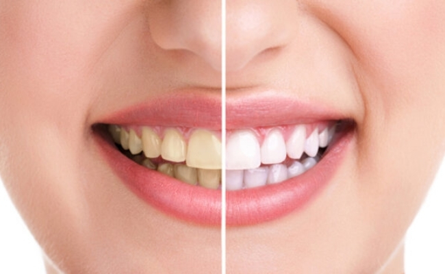 Teeth Whitening-