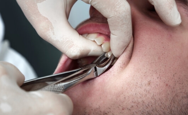 Tooth Extractions